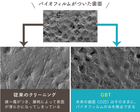 バイオフィルムがついた歯面→従来のクリーニング（線＝傷がつき、摩耗によって表面が滑らかになってしまっている）→GBT（本来の歯面の凸凹はそのままに、バイオフィルムのみを除去できる）