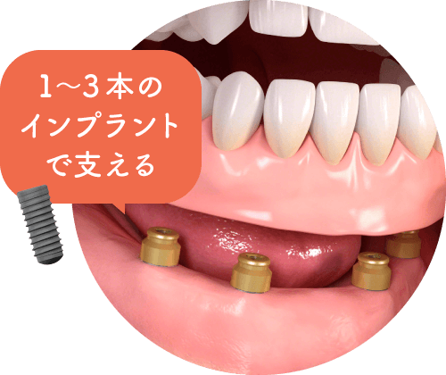 1〜3本のインプラントで支える