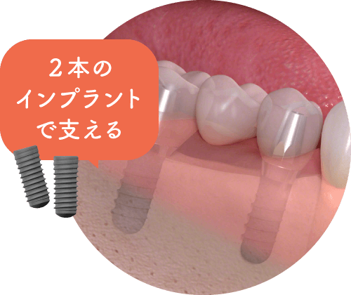 2本のインプラントで支える